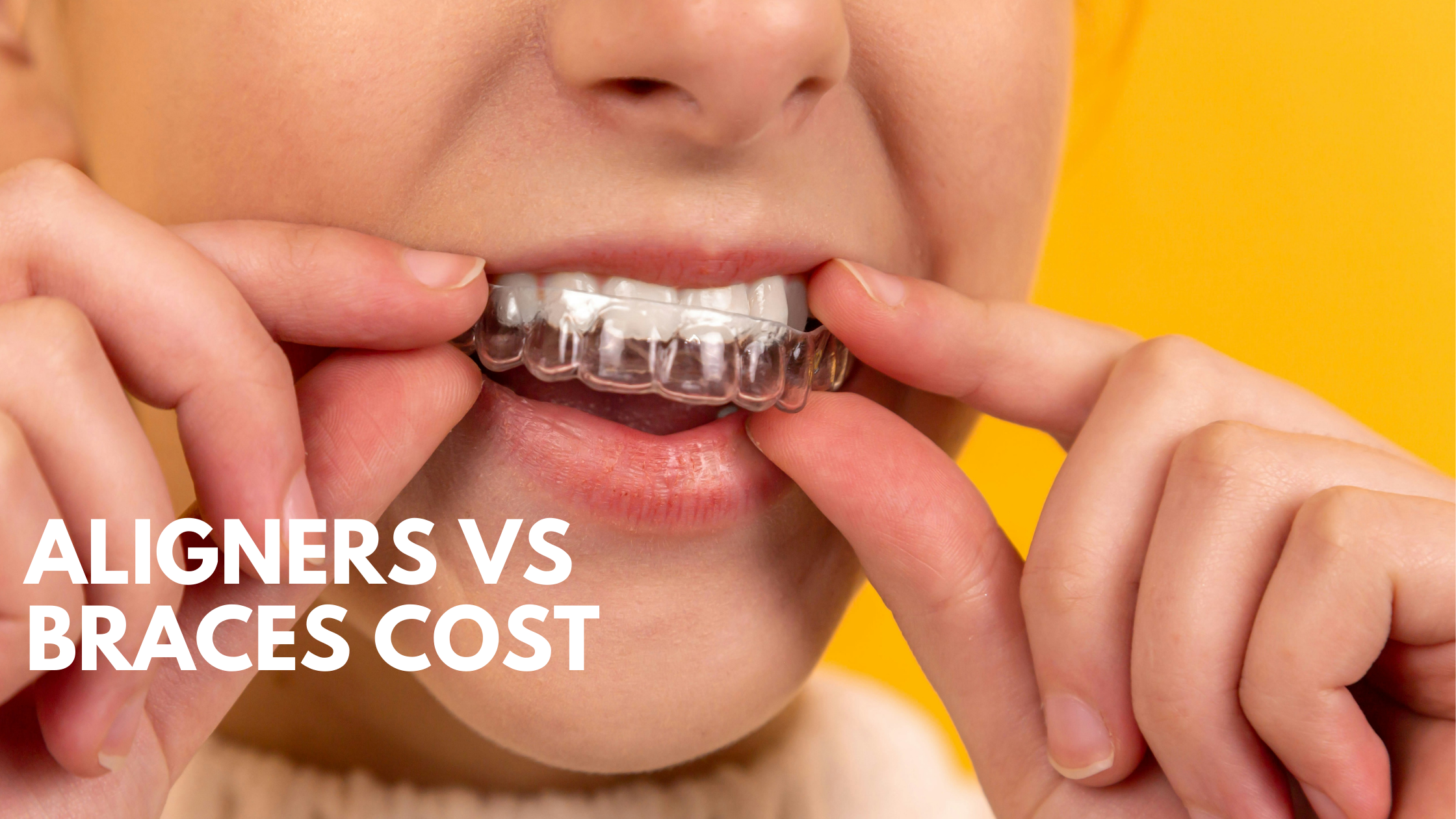 Aligner and Braces cost